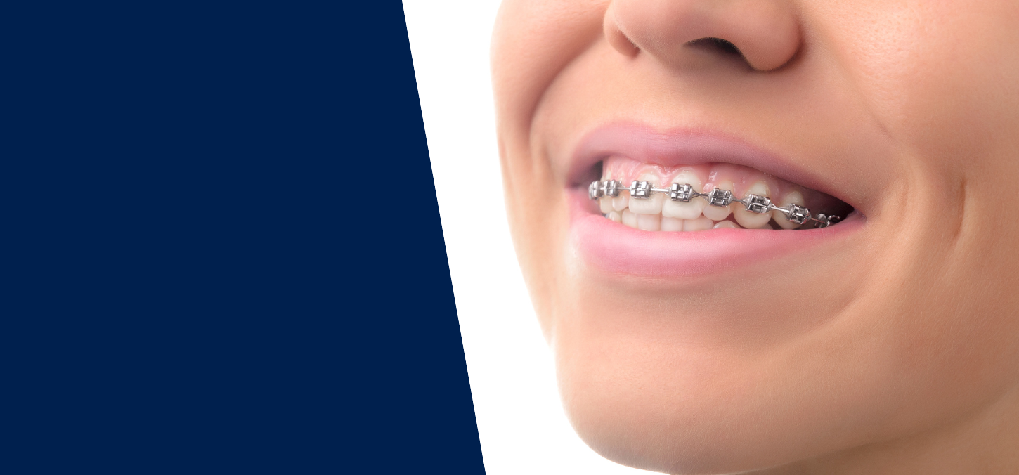 Braces | Orthodontics Clinic