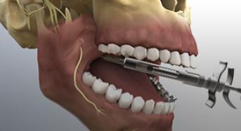 Dental Implants Windsor