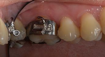 Ortho bands clearance