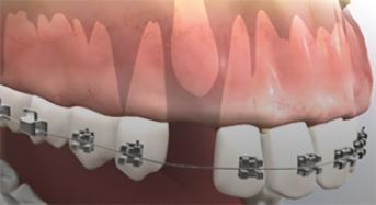 Impacted Canine Tooth Surgery 