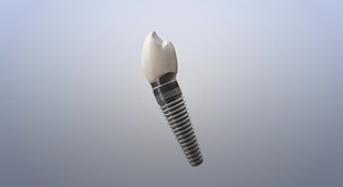 Implant for a Single Tooth