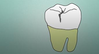 What are cavities? 